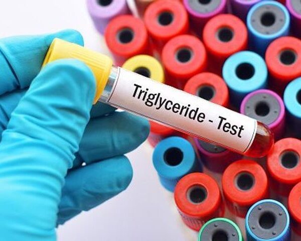 triglycerides test